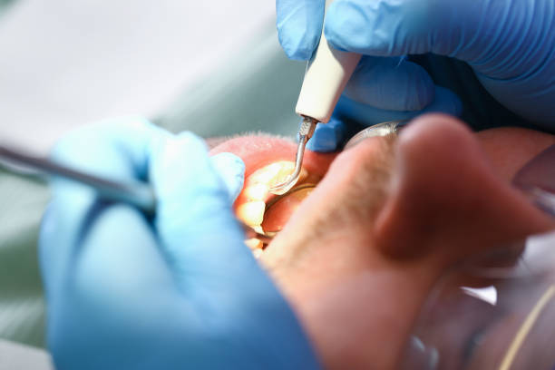 Best Emergency Dentist for Lost Fillings or Crowns in Canon, GA